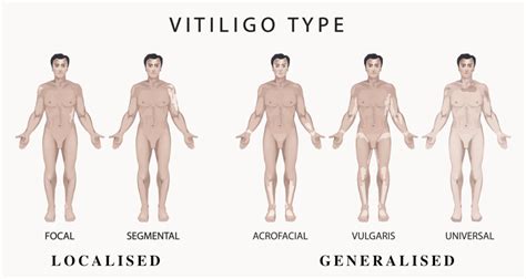 What is Vitiligo? | Causes, Signs, Symptoms, & More | Vitiligo Society