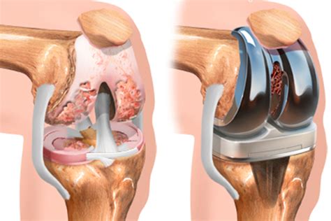 Inmuebles Referéndum hipótesis retiro de protesis de rodilla infectada ...