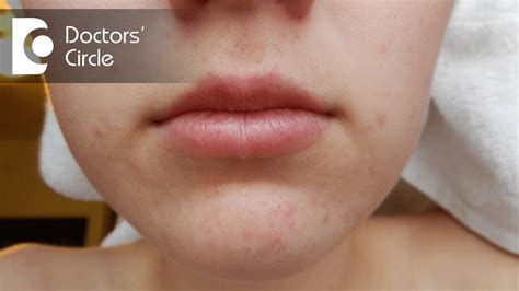 What Cause Pimples On The Lips | Lipstutorial.org