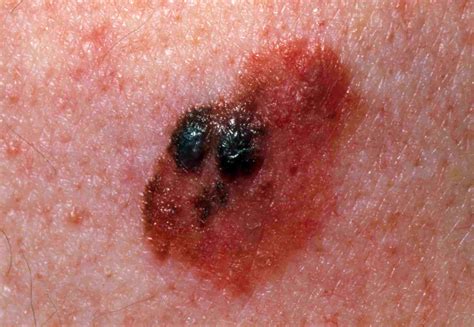 Spot the Differences Between a Mole and Skin Cancer