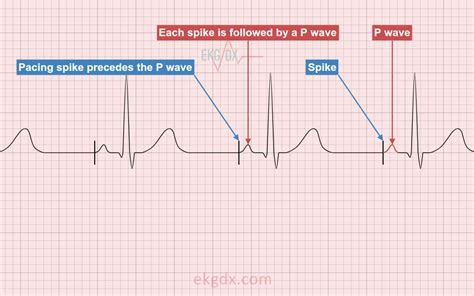 Ecg Interpretation Electronic Pacemaker Spikes Ekg | SexiezPix Web Porn