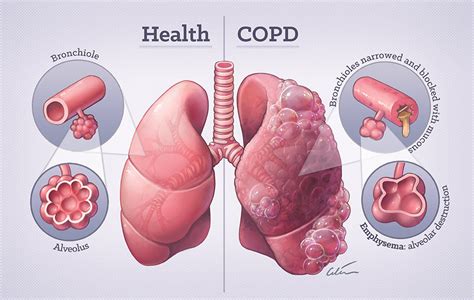 Bệnh phổi tắc nghẽn mạn tính (COPD) - Raffles Hospital