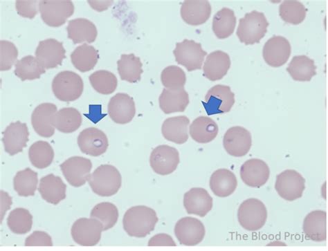 Babesia • The Blood Project