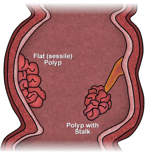 Polyps of the Colon and Rectum | ASCRS