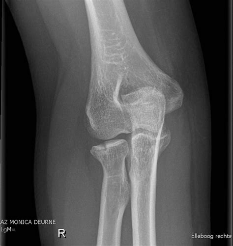 Radial Head Fracture Classification