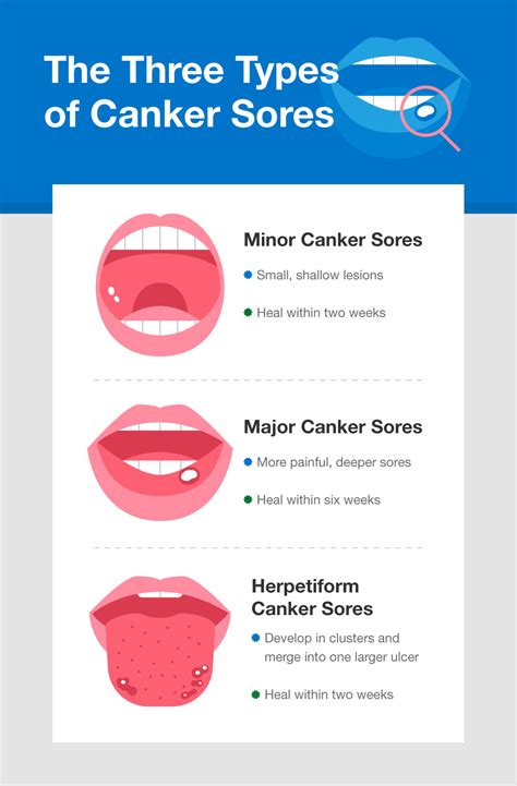 What Causes Canker Sores and How to Get Rid of Them - SmartMouth