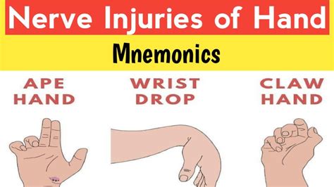 Ape Hand,Wrist Drop,Claw Hand |Radial,ulnar,median nerve injuries - YouTube