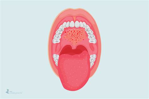 COVID-19 Might Cause Mouth Lesions, New Study Suggests