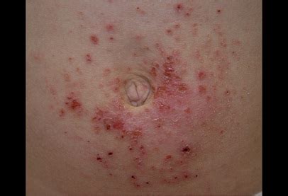 Contact Dermatitis Causes, Symptoms, Diagnosis and Treatment - Natural ...