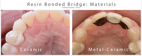 Resin Bonded Bridge: Minimally Invasive Option for Tooth Replacement ...