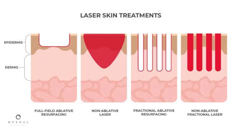 Fractional Erbium Laser Vs CO2 Laser: Which is better? - Ensoul Medical ...