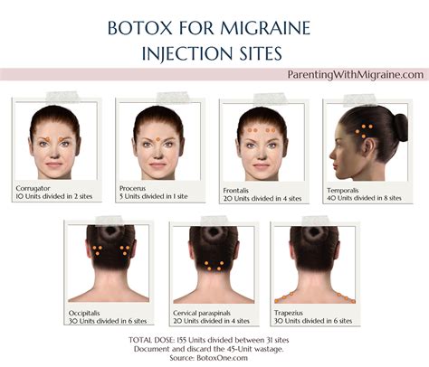 Botox For Migraine: Everything You Need To Know — PARENTING WITH MIGRAINE