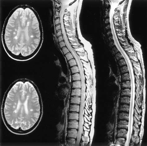 Multiple Sclerosis (MS) | Conway Homer, P.C.