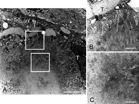 Figure3.Electron microscopic findings. A. Amyloid fibrils in an ...