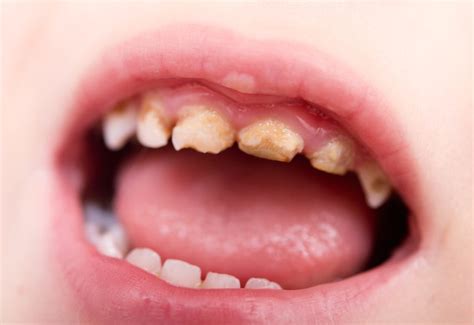 Tooth Decay in Children - Has NHS Dentistry been failing us?