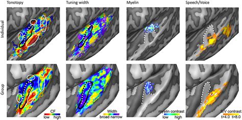 Anatomical and functional characterization of human auditory cortex ...