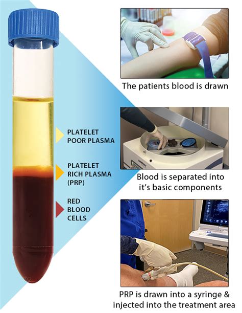 Prolotherapy Formulas - Platelet-Rich Plasma - PRP | Prolotherapy.com ...