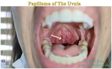 A Simple Partial Uvulectomy Technique Under Local Anesthesia For The ...