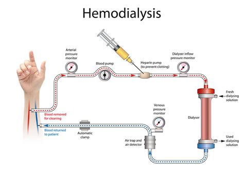 Hemodialysis: What to Expect | HealthCommunities Provider Services