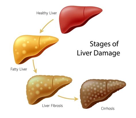 Progress Of Liver Disease Liver