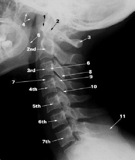 Cervical Vertebra Lateral View