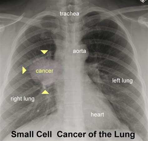 Liver Cancer: Liver Cancer X Ray Images