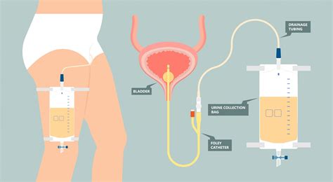 What's a Foley catheter? | Roswell Park Comprehensive Cancer Center ...