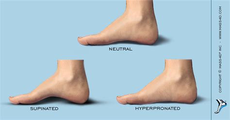 Understanding the Medial Arch Height - MASS4D® Foot Orthotics