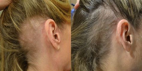 Female Hair Loss Case Study - PRP Injection Therapy - Hair Restoration ...