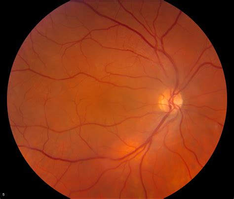 Aniridia Fundus RE | UK EGG - The UK Eye Genetics Group