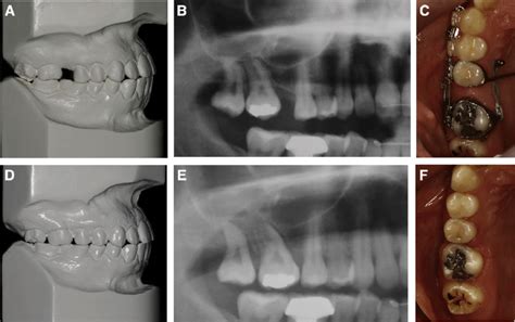 Patient 4: A, An early maxillary first molar extraction and overerupted ...