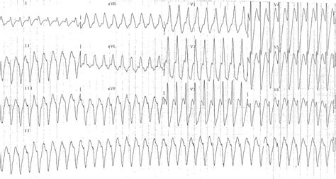 Ventricular Tachycardia Ecg