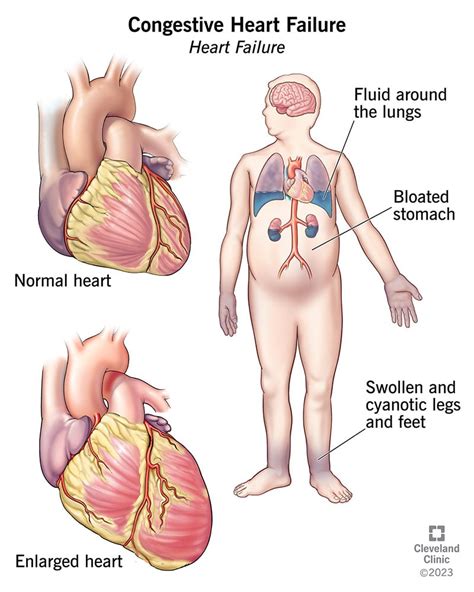 Understanding Congestive Heart Failure - Ask The Nurse Expert