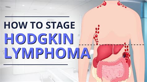 Hodgkin Lymphoma Staging: From Diagnosis to Prognosis | The Patient ...