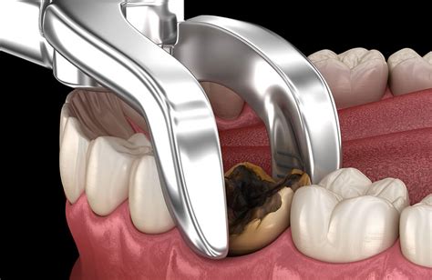 Tooth Extraction Cost for 2021, Procedure, Risks, & Recovery