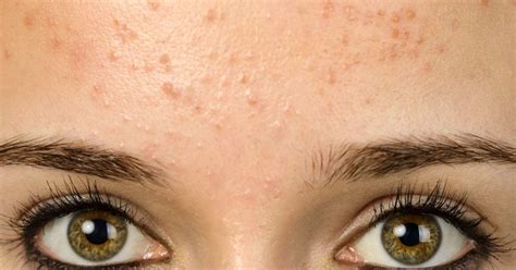 Forehead acne and pimples: Causes, treatment, and prevention