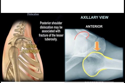 Posterior Shoulder Dislocation — OrthopaedicPrinciples.com