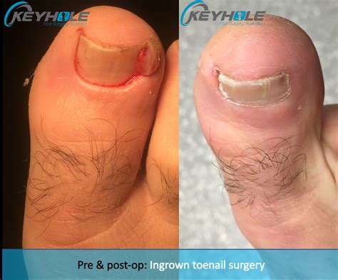 Ingrown Toenail Surgery Perth | Perth Podiatric Surgery