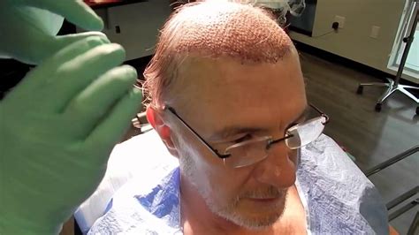 Best Hair Transplant Surgery by Hair Restoration Surgeon - YouTube