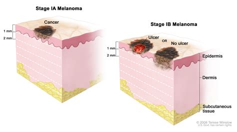 Stage 4 Melanoma Skin Cancer