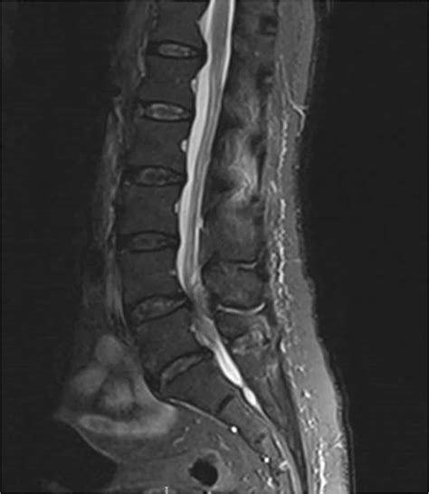 Cauda Equina Syndrome (CES) - almostadoctor