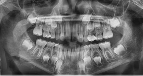 Baby Teeth Panoramic Xray | linkskadel