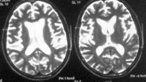 Axial T2 MRI images showed bilateral severe temporal and frontal lobe ...