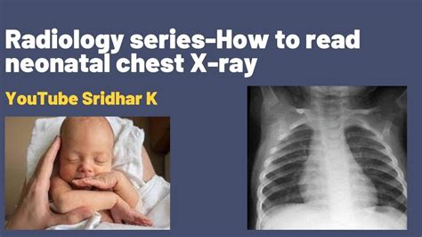 Normal Infant Chest Xray