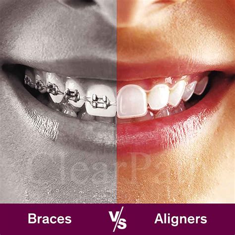 Clear Braces Costs Best Brands, Pros Cons, 57% OFF