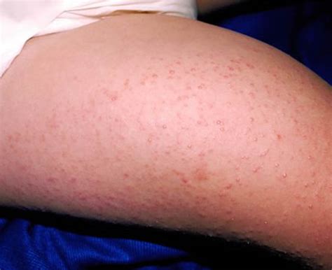 Keratosis Pilaris - Causes, Symptoms, How To Get Rid of It