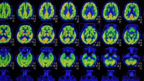 Nuclear Medicine Imaging and PET/CT at Tualatin Imaging in Oregon