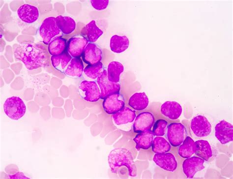 Acute Myeloid Leukemia: What Your Patients Need to Know - Hematology ...