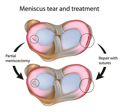 Failure of meniscus repairs | Dr. David Geier - Sports Medicine Simplified