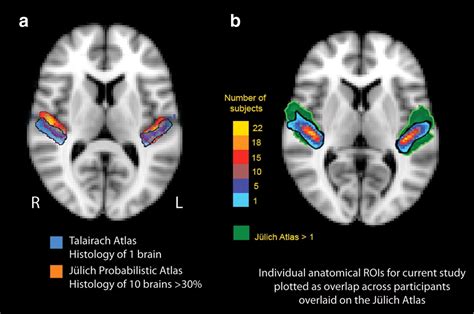 Auditory Cortex Mri